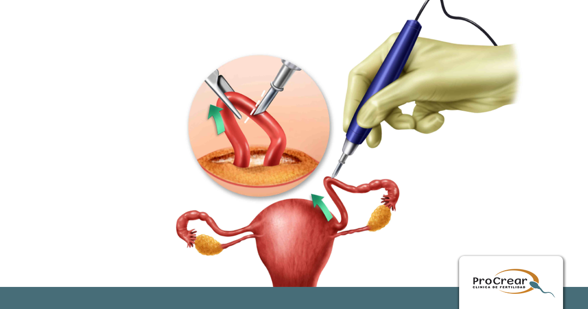 Ligadura de trompas El sueño de volver a ser madre Procrear Ligadura de trompas El sueño de volver a ser madre Procrear