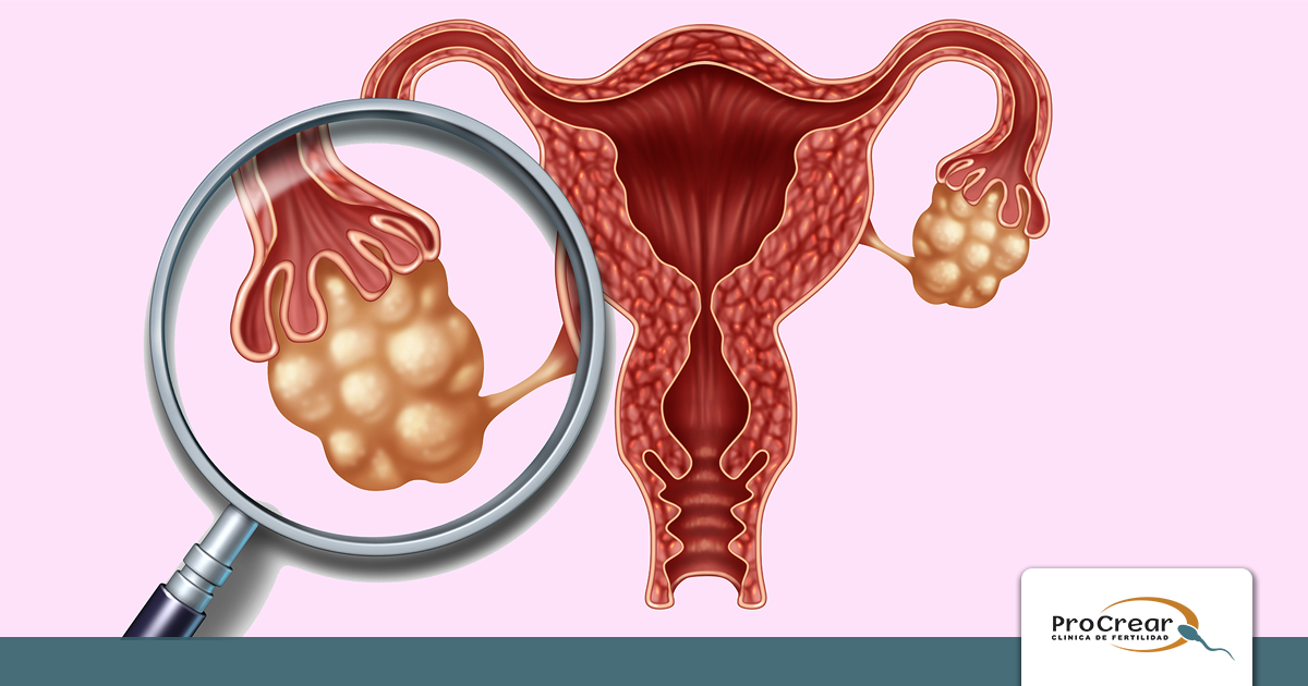 Reserva Ovárica ¿influye en la fertilidad? Procrear